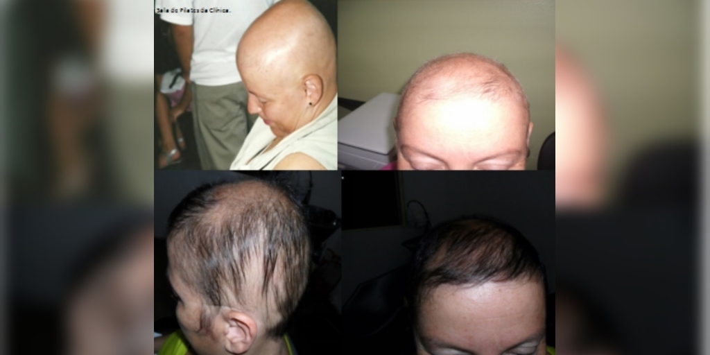 Antes e o depois de tratamento feito em clínica da tricologista Silvia Barreto
