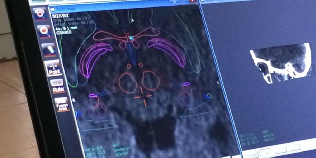 Cirurgia de reversão da doença de Parkinson é realizada com o paciente acordado 