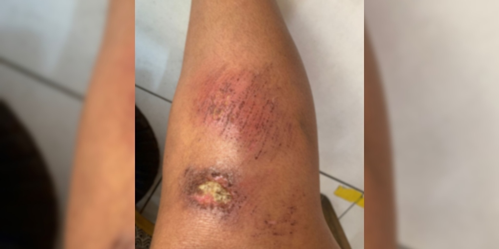 Moradora se machuca após cair por causa de buraco 