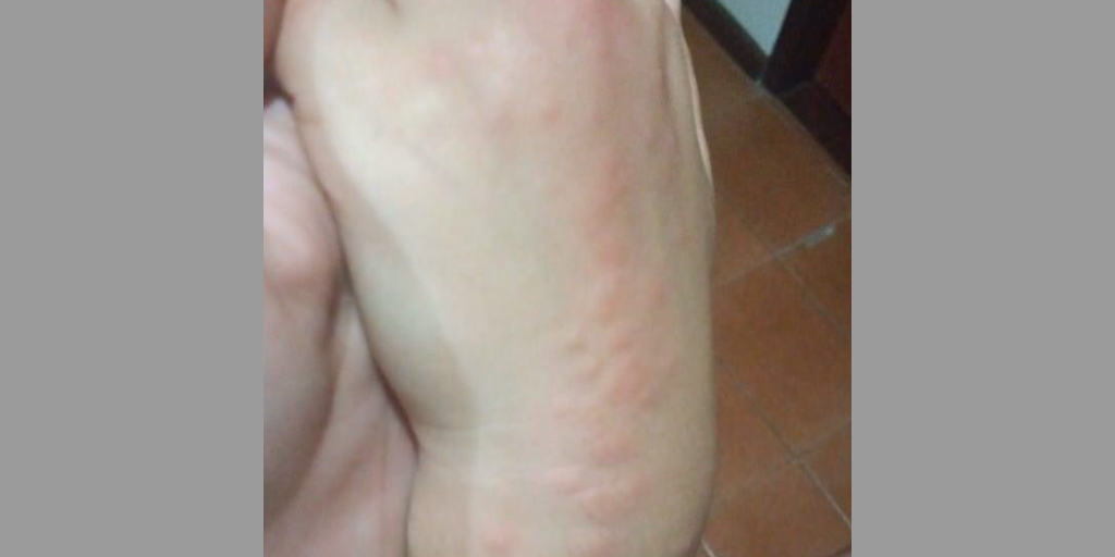 Mão de criança foi queimada pelos tentáculos do animal em praia de Arraial do Cabo