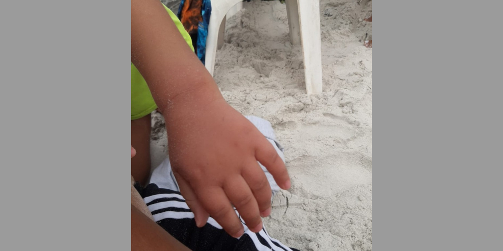 Mais uma criança é queimada por caravela-portuguesa na Região dos Lagos do Rio