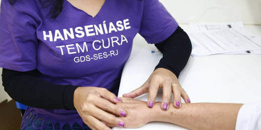 Nova Friburgo vai receber unidade móvel de prevenção e combate à hanseníase