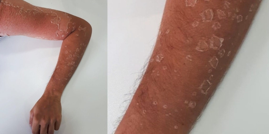 Descamação da pele após queimaduras de sol em turista na Região dos Lagos